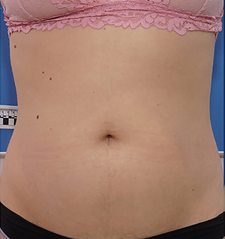 Morpheus8® Treatment - Before