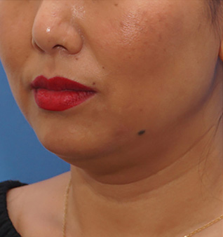 Morpheus8® Treatment - Before