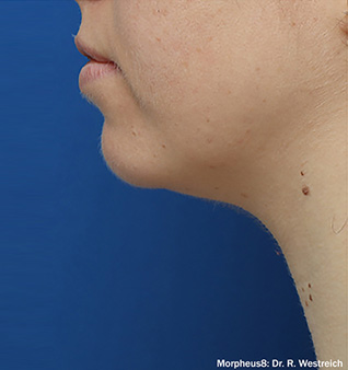 Morpheus8® Treatment - After