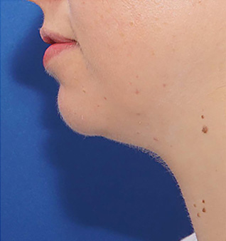 Morpheus8® Treatment - Before