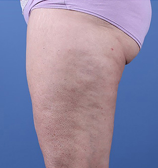 Morpheus8 before and after photo of legs