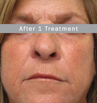 Morpheus8 before and after images of face