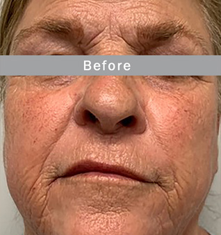 Morpheus8 before and after images of face