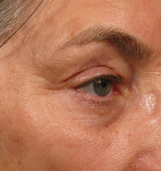 Ultherapy® Treatment - After