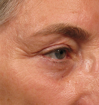Ultherapy® Treatment- Before