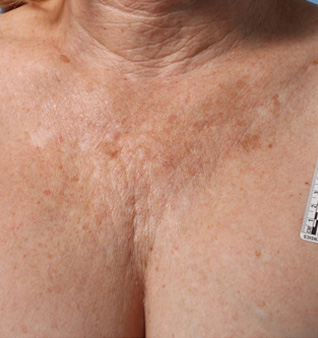 Ultherapy before and after photos of chest