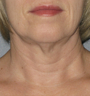 Ultherapy® Treatment- Before