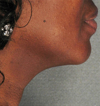 Ultherapy® Treatment - After