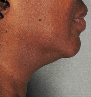 Ultherapy® Treatment- Before