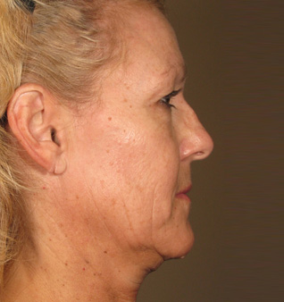 Ultherapy® before and after photos of chin