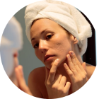 acne-scrarring