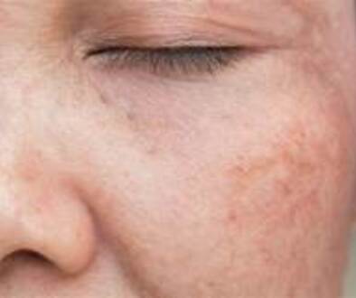 Age spots and sunspots