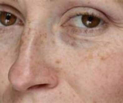 Dark spots and sun damage