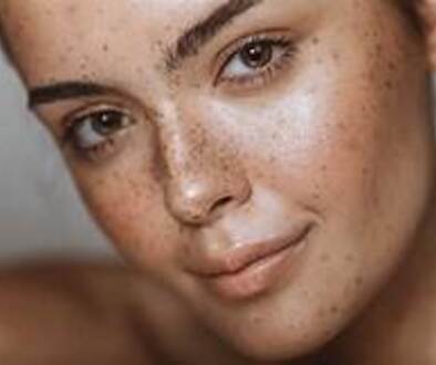 Hyperpigmentation