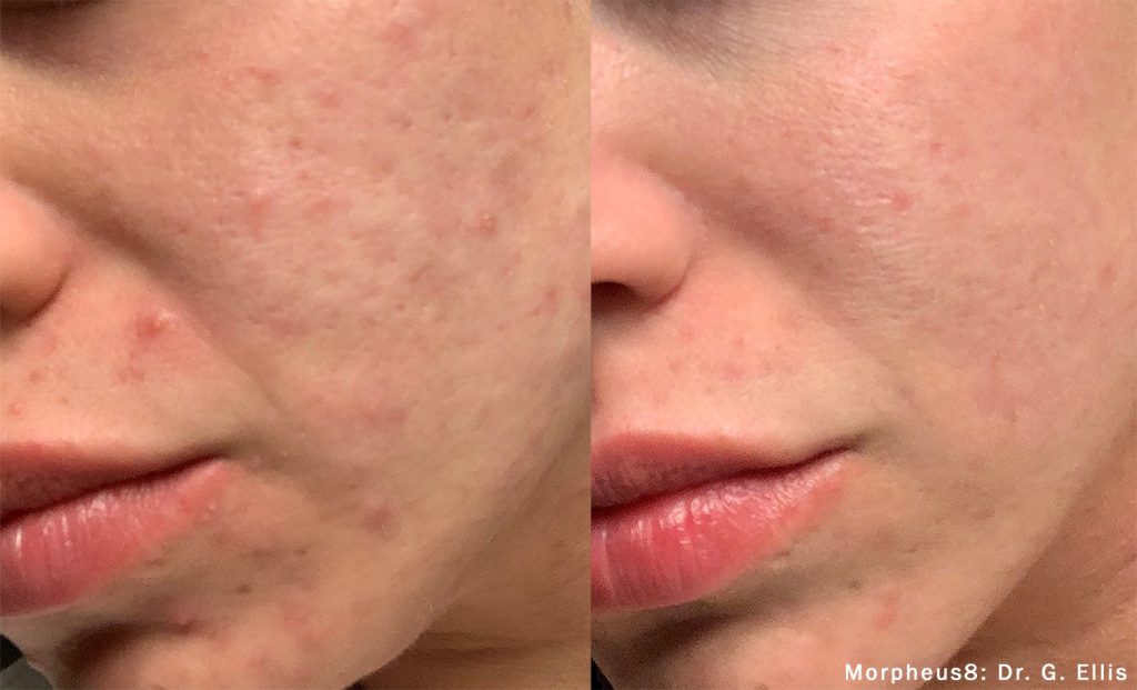 Before and After photos of Morpheus8 