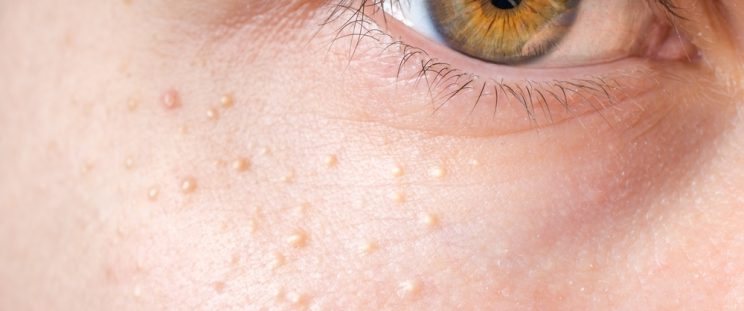 A woman with milia on her skin below the eyes