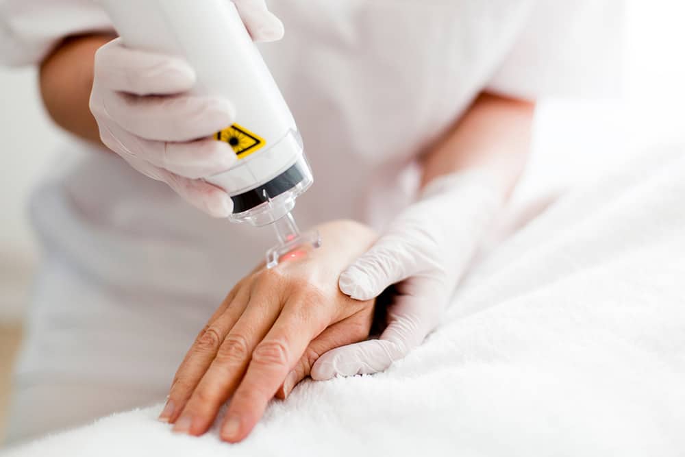  laser skin resurfacing being performed on a hand