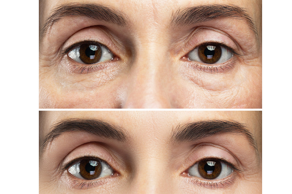  Image of a woman before and after Morpheus8 treatment