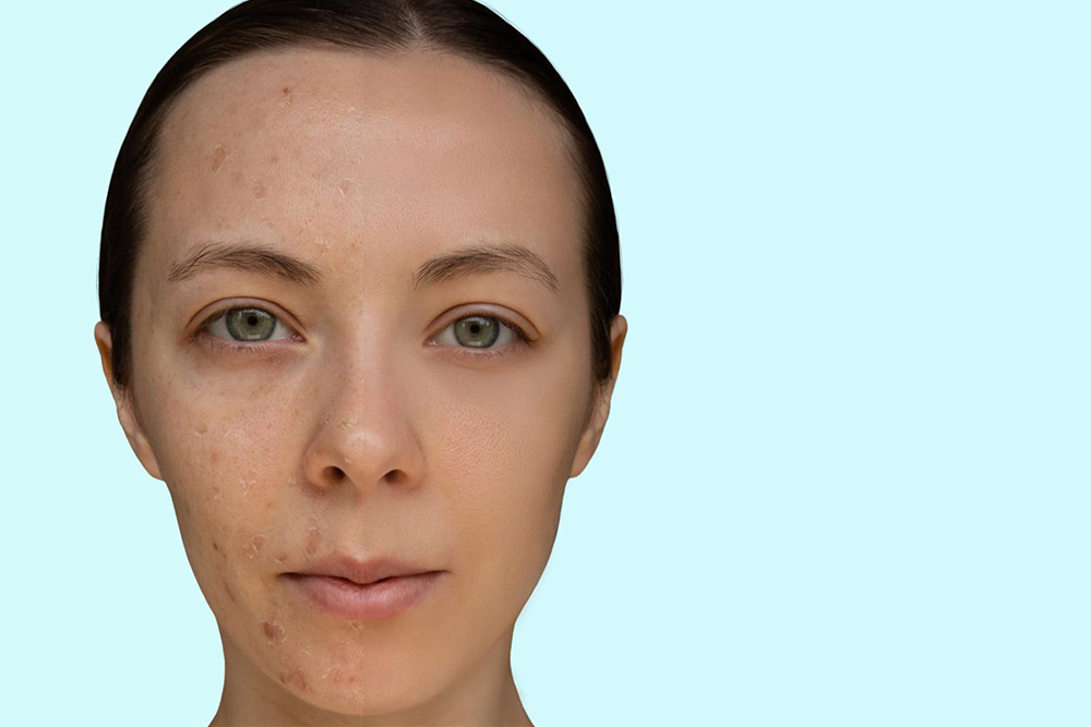 A woman’s face showing the before and after of a chemical peel