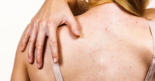 A woman with active acne on her back