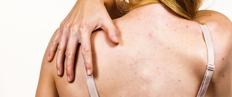 A woman with active acne on her back