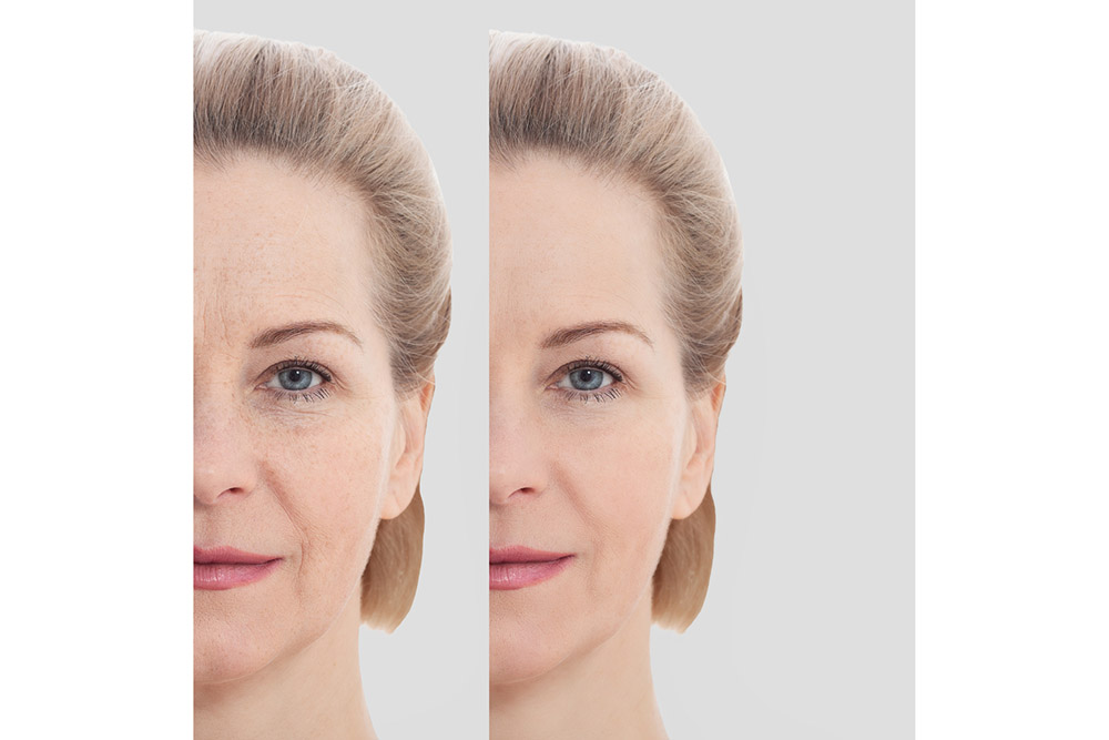 A woman before and after undergoing Forever Young BBL treatment