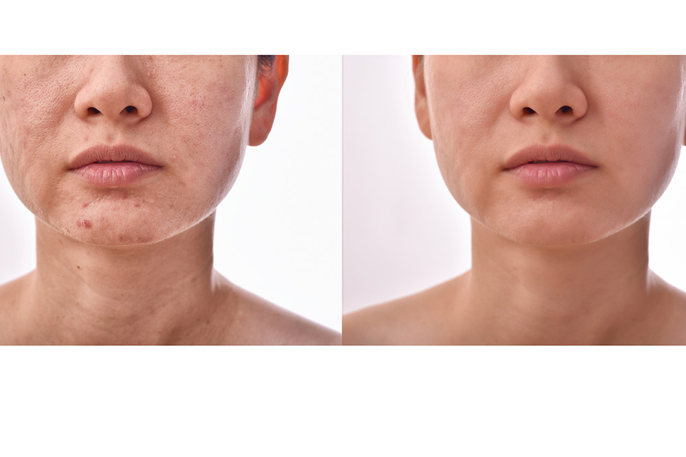 An image of a woman’s face before and after Forever Clear BBL treatment