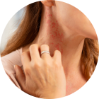 Morpheus8 Treatment Allergic Reaction - APT Medical Aesthetics