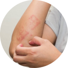 Morpheus8 Treatment Infection - APT Medical Aesthetics