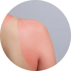 Temporary Redness And Swelling - APT Medical Aesthetics