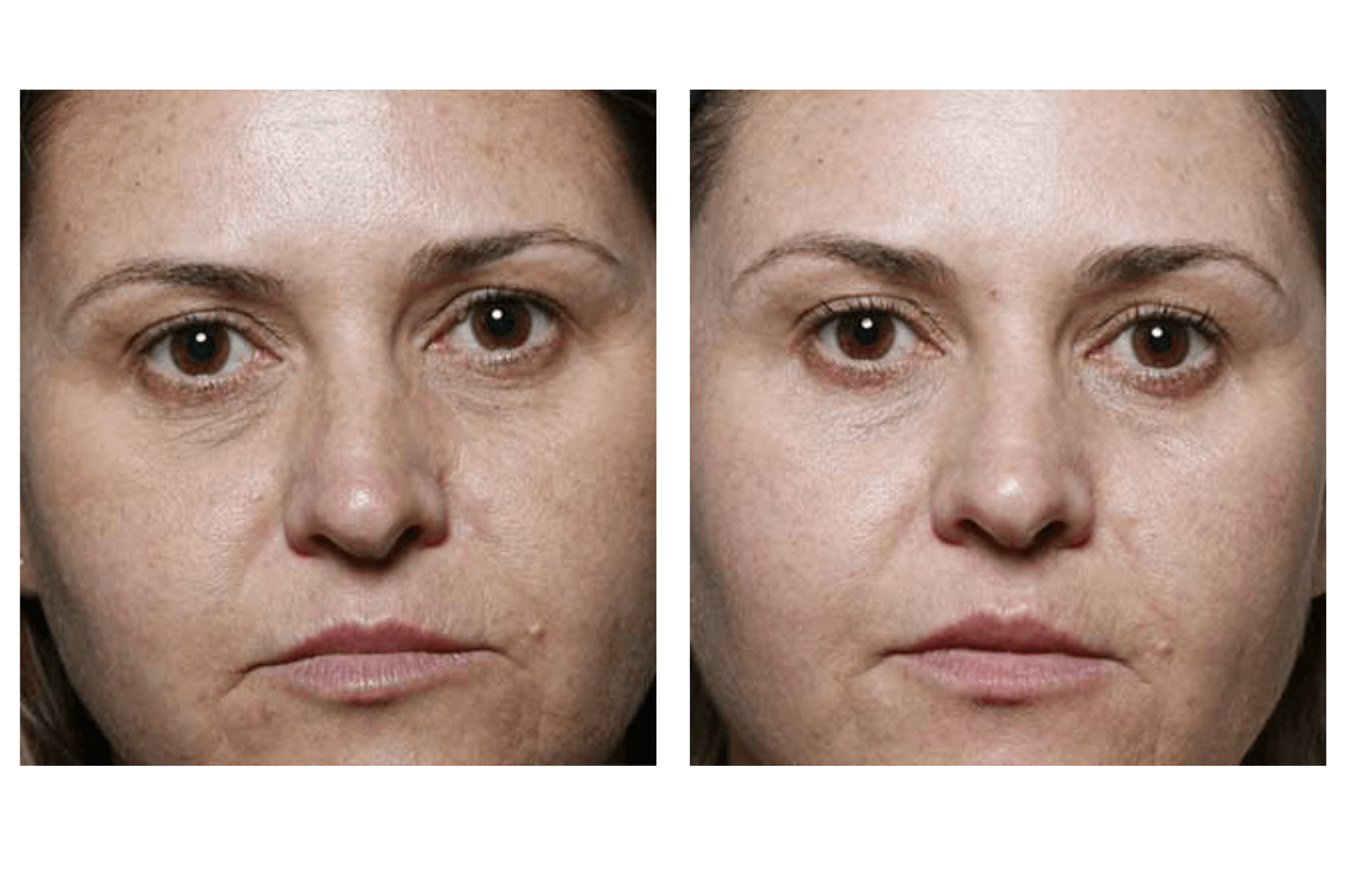The before and after results of a patient who has undergone a Clear + Brilliant session