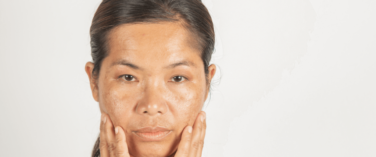 a person’s face with signs of uneven skin tone and hyperpigmentation