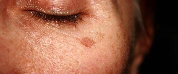 A patient with dark spots on her skin