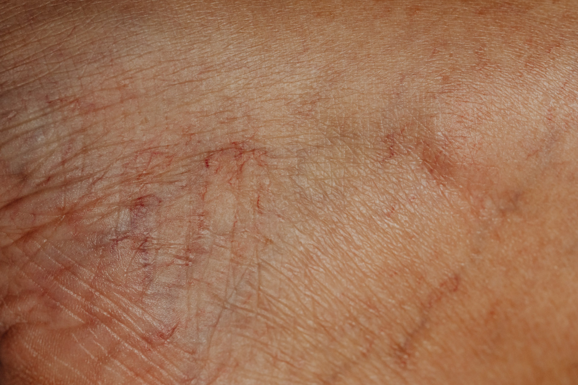 Spider veins up close