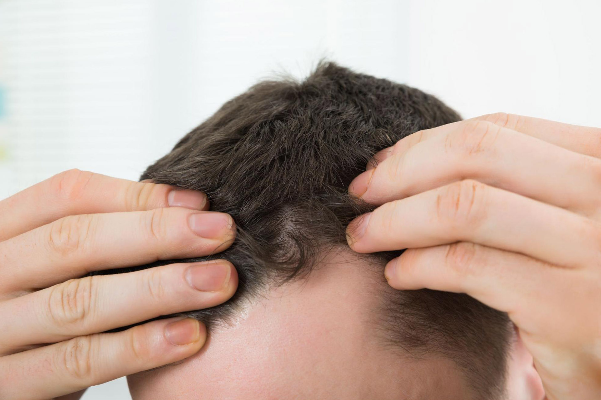 A close up of a man’s receding hairline