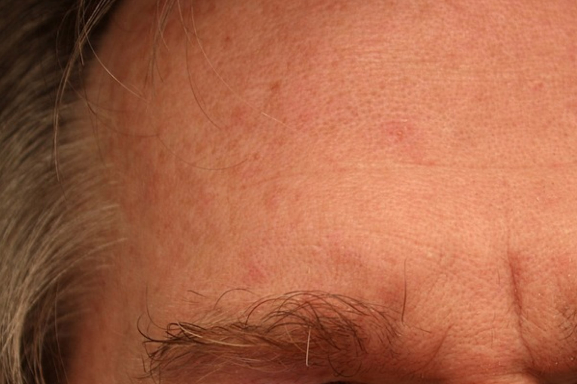 Forehead wrinkles, an example of what Morpheus8 and microneedling can treat