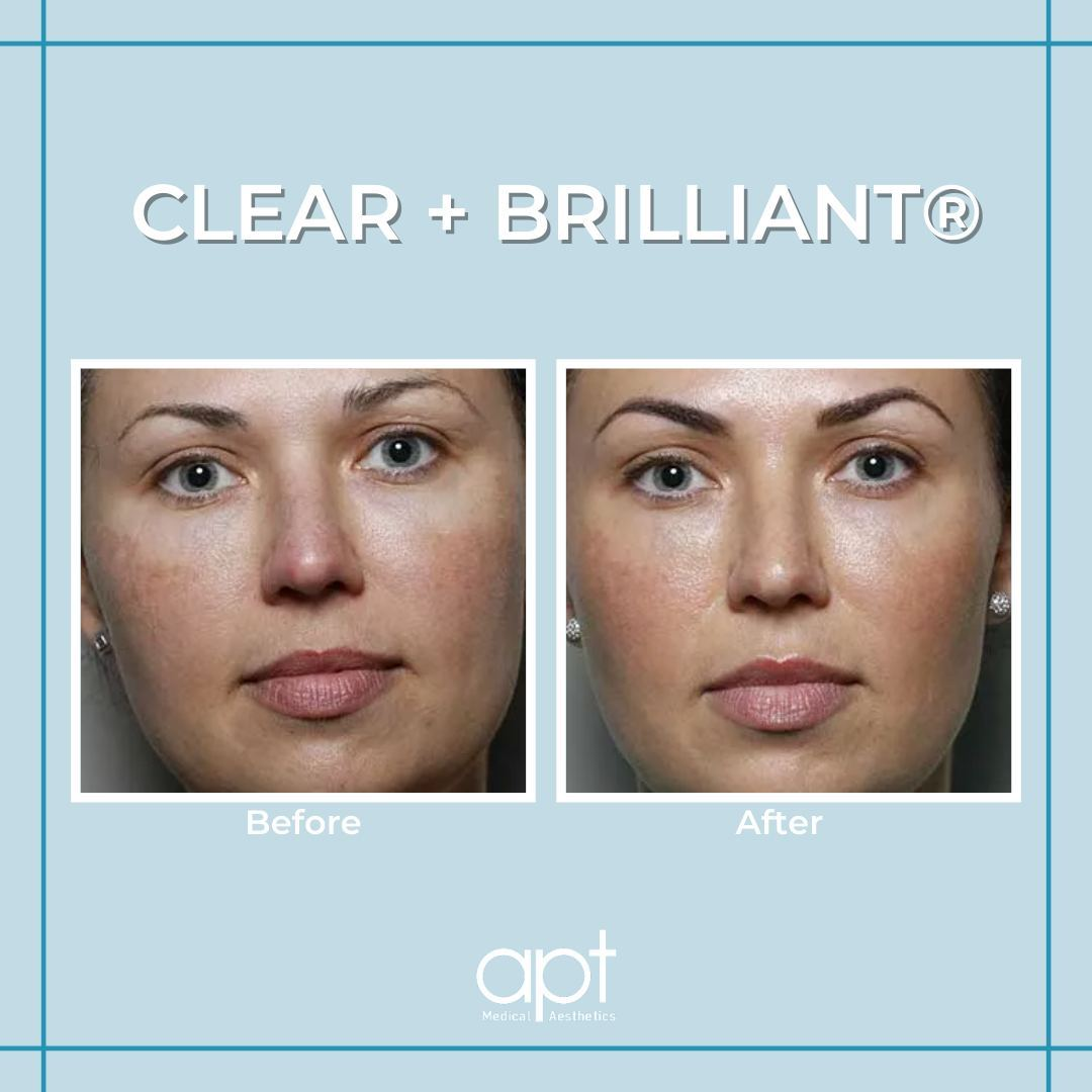A before and after comparison for Clear + Brilliant® 