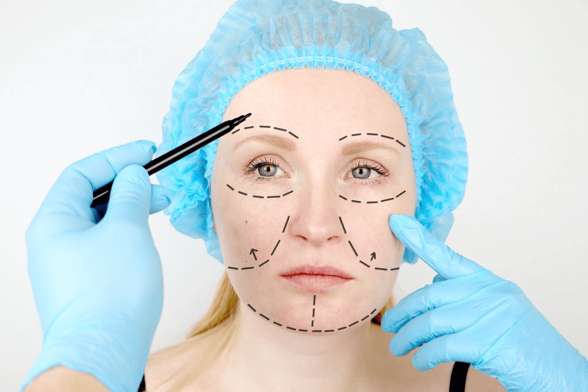  A woman marking her face to prepare for a SMAS lift.
