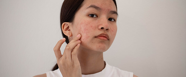 A woman with noticeable acne on her T-zone, cheeks, chin, and jawline