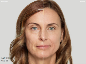 Sculptra: (Before + After 27 Weeks)
