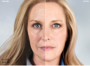 Sculptra, Before + After 25 Months of 3 Treatments - APT Medical Aesthetics