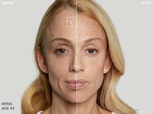 Sculptra Treatment, Before + After 24 Months - APT Medical Aesthetics