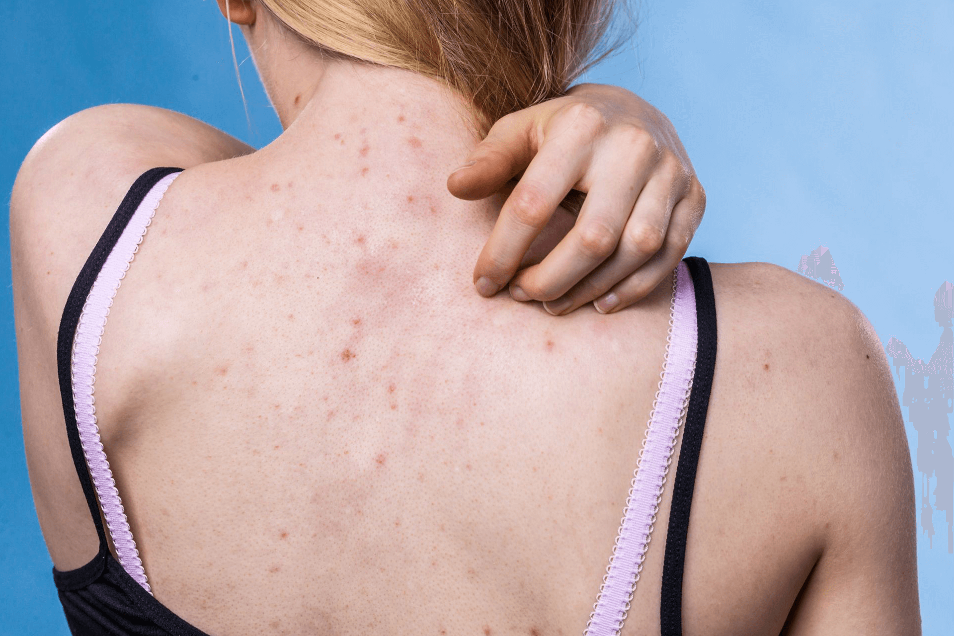  A woman scratching an acne breakout on her upper back
