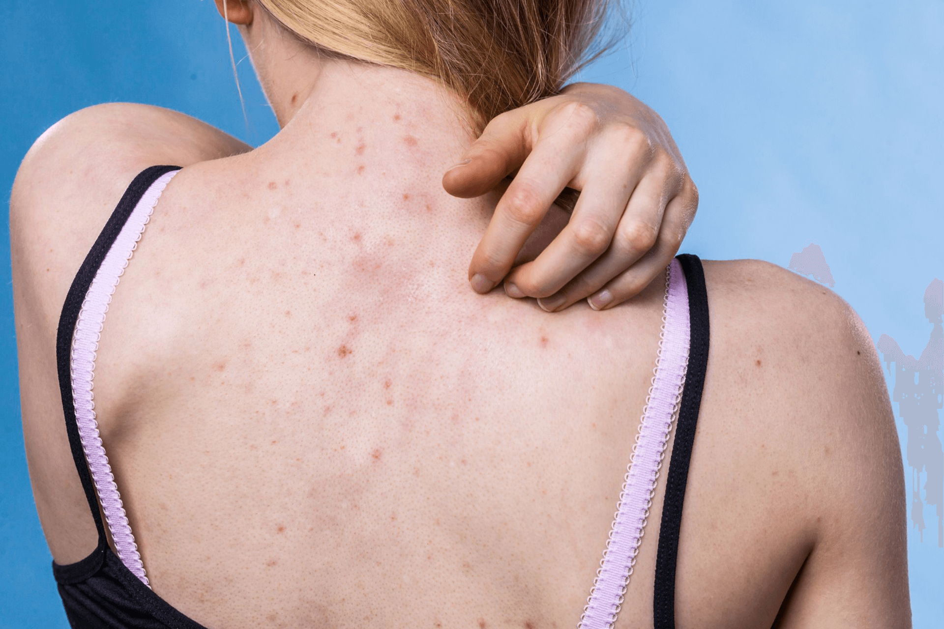 Best Treatments for Cystic Acne on Jawline | APT Medical Aesthetics