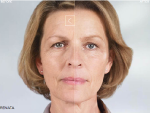 Sculptra, Before + After 25 Months of 3 Treatments - APT Medical Aesthetics