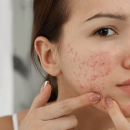 A woman picking at pimples on her lower cheek