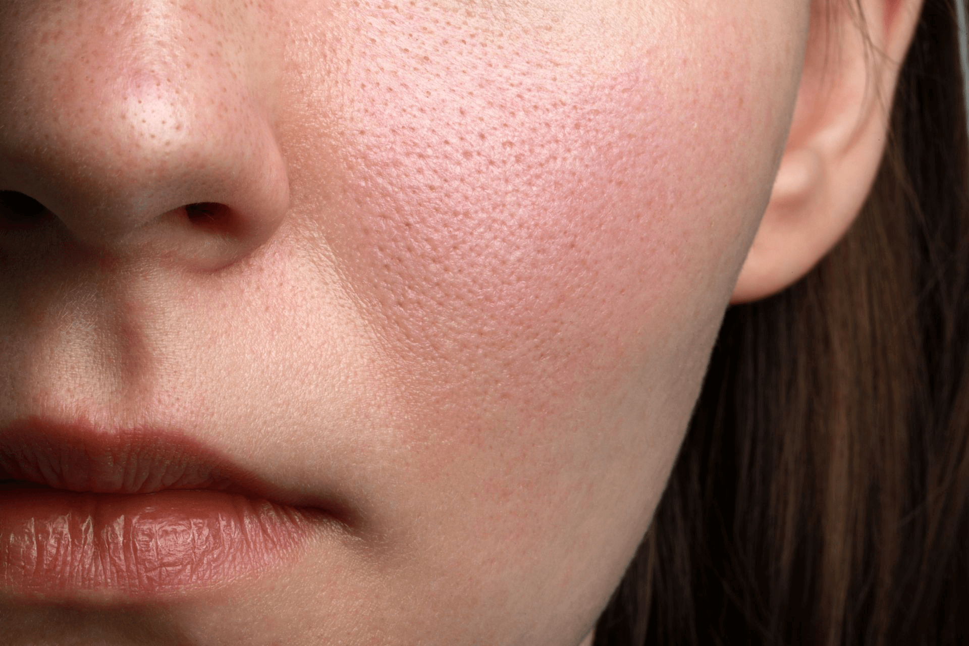  A woman with noticeable enlarged pores on her left cheek 