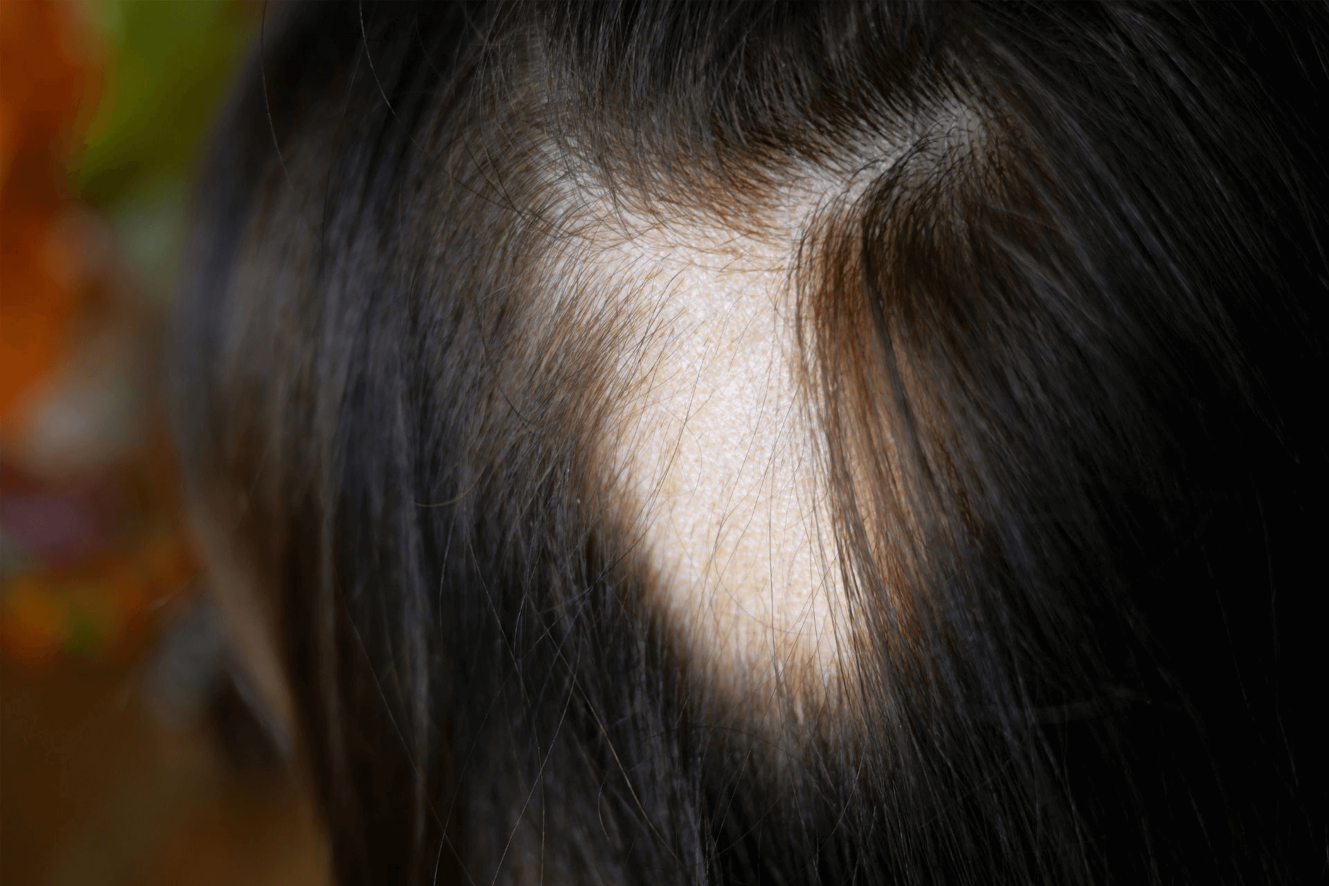 A person with a bald spot in the middle of their scalp 