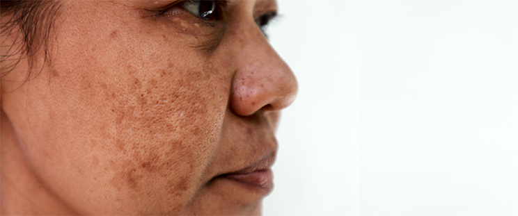 Side profile of a woman with skin pigmentation on face