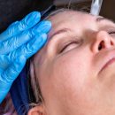 A patient having micro-needling therapy done on her forehead at APT Medical Aesthetics